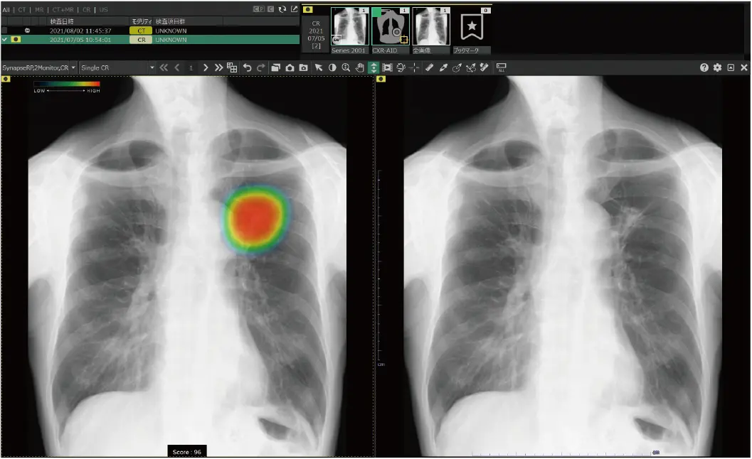 胸部X線画像を自動解析